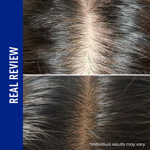 ViveLab Spioxyl™ Scalp Serum 400 – 220K Micro-Spicules for Thicker, Fuller Hair | Dermatologist-Recommended K-Beauty Scalp Serum (0.5 fl oz)