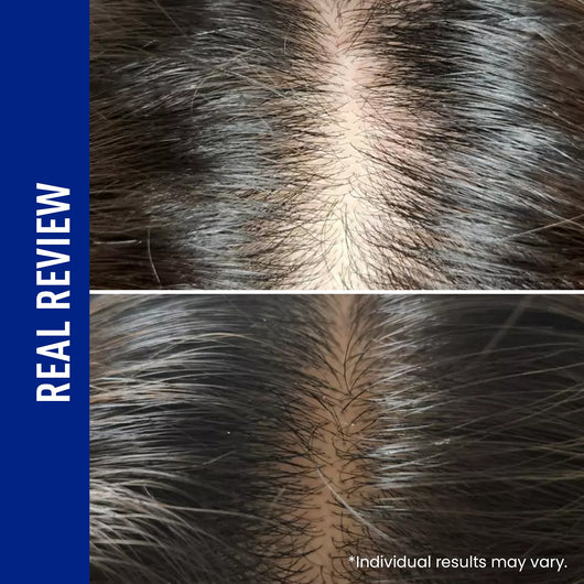 ViveLab Spioxyl™ Scalp Serum 400 – 220K Micro-Spicules for Thicker, Fuller Hair | Dermatologist-Recommended K-Beauty Scalp Serum (0.5 fl oz)