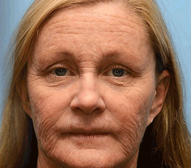 Evora's Rolimey® Botox & Vita-A Retinol Wrinkle-Lift Cream – Made & Shipped in the USA