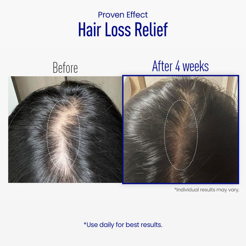 ViveLab Spioxyl™ Scalp Serum 400 – 220K Micro-Spicules for Thicker, Fuller Hair | Dermatologist-Recommended K-Beauty Scalp Serum (0.5 fl oz)